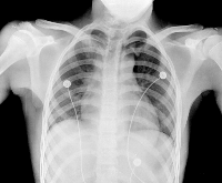 Fig0107(a)(chest xray vandy)