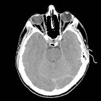 Fig0107(c)(headCT Vandy)