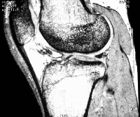 Fig0117(a)(MRI of knee Univ Mich)