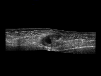 Fig0120(d)(ultrasound muscle layers with lesion)