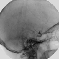 Fig0228(b)(angiography live  image)