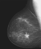 Fig0304(a)(breast digital Xray)