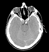 Fig0359(a)(headCT Vandy)