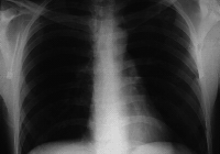 Fig0459(a)(orig chest xray)