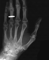 FigP0436(left)(hand xray)